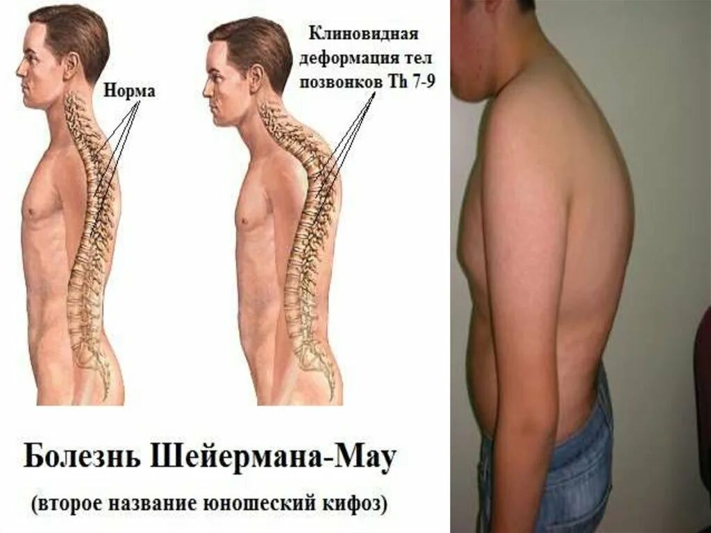 Кифоз болезнь Шейермана-МАУ. Кифосколиоз (болезнь Шейермана-МАУ). Кифоз позвоночника болезнь Шейермана. Искривление позвоночника Шейермана МАУ.