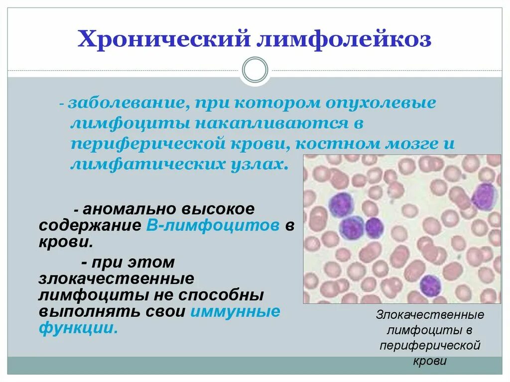 B хронический лимфолейкоз. В -лимфоциты хронический лимфолейкоз. Хронический лимфолейкоз характеризуется. Хронический лимфолейкоз субстрат. Хронический лимфолейкоз и хронический миелолейкоз.