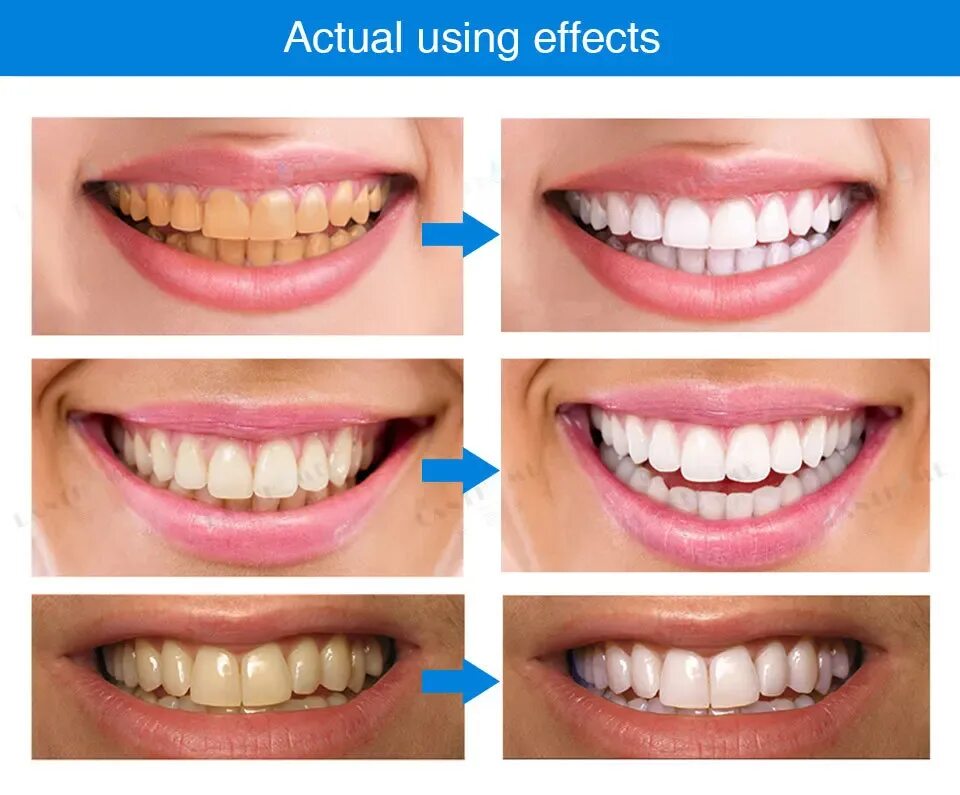 отбеливание зубов, отбеливающие полоски для зубов, отбеливающие зубные полоски, отбеливающие полоски для зубов до и после