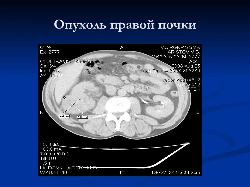 Опухоль правой почки