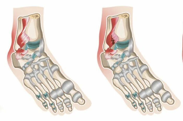 Капсульно-связочный аппарат стопы. Капсульно-связочный аппарат голеностопного сустава. Дисторсия капсульно-связочного аппарата голеностопного сустава. Разрыв сухожилия голеностопного сустава.