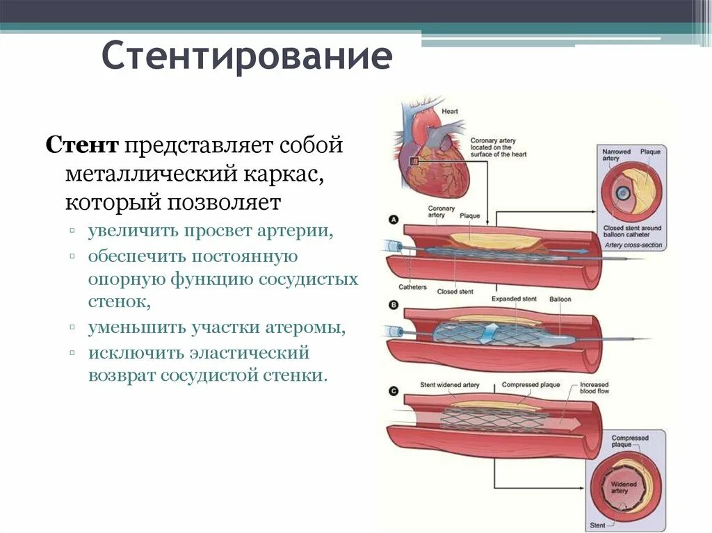 Срок стентирования. Атеросклероз стентирование. Непокрытый стент для пищевода. Методика стентирования пищевода.