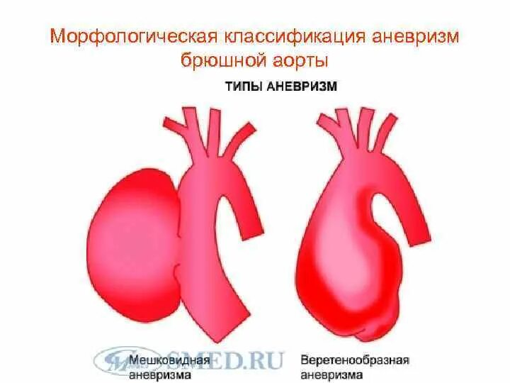 Мешотчатая аневризма аорты. Классификация аневризм брюшного отдела аорты. классификация аневризм аорты. классификация аневризм брюшной аорты. классификация аневризм восходящего отдела аорты.