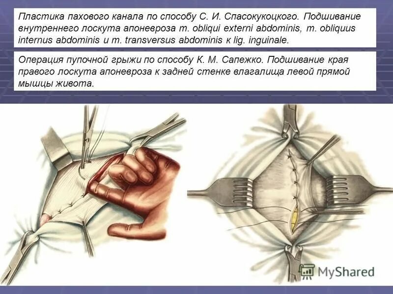 Способы пластики пахового канала. Пластика пожирару спасокукоцуому. Паховая грыжа по жирару-спасокукоцкому. Пластика пахового канала по спасокукоцкому. Пластика по жирару спасокукоцкому со швами кимбаровского.
