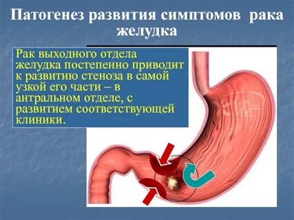 Привратник желудка симптомы