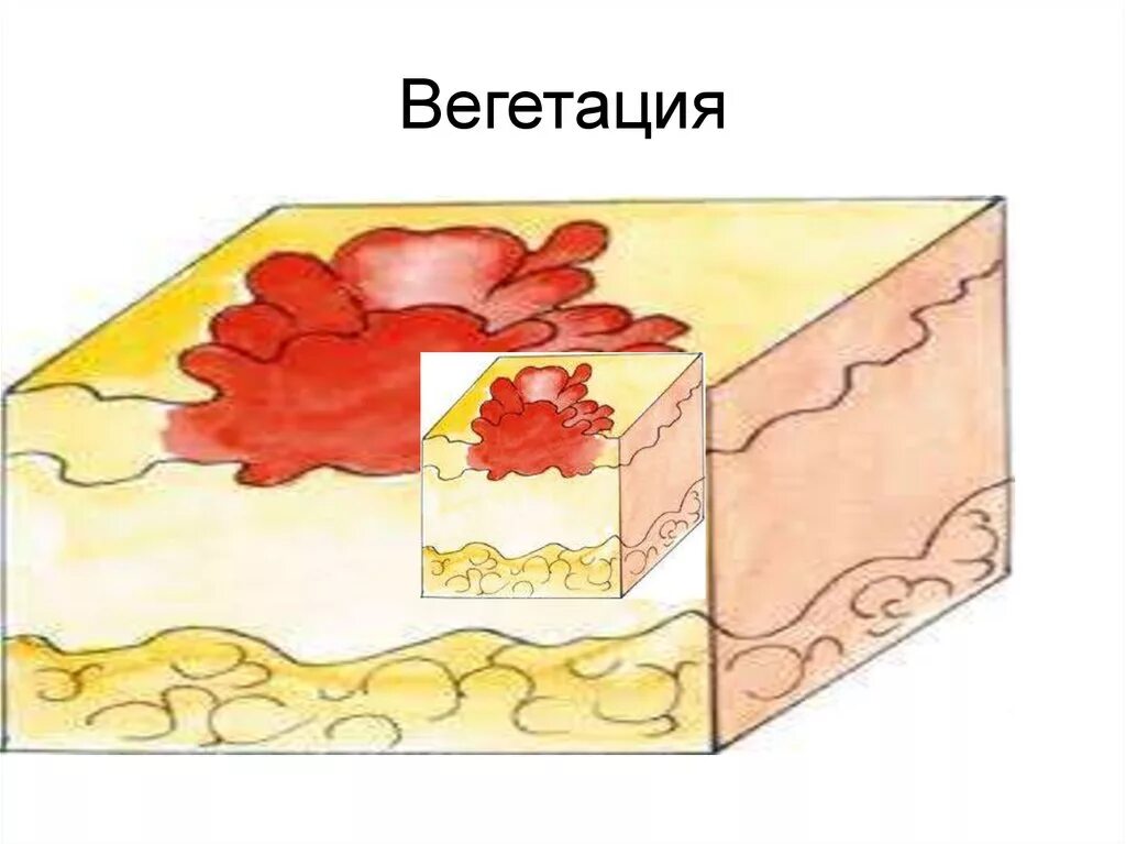 Вегетация определяется. Вторичные морфологические элементы кожи лихенификация. Вегетация вторичный морфологический элемент. Вторичные элементы сыпи вегетация.