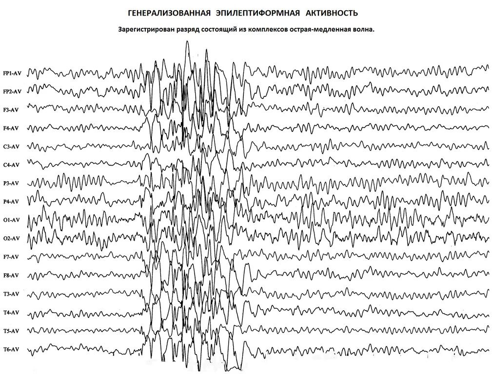 Ээг ответ. Генерализованная Спайк волна на ЭЭГ. Эпи активность у детей на ЭЭГ. Энцефалограмма эпилептические активность. Генерализованная эпилептиформная активность на ЭЭГ У ребенка.