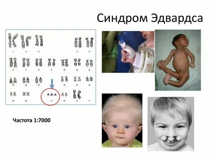 Кариотип больного с синдромом эдвардса