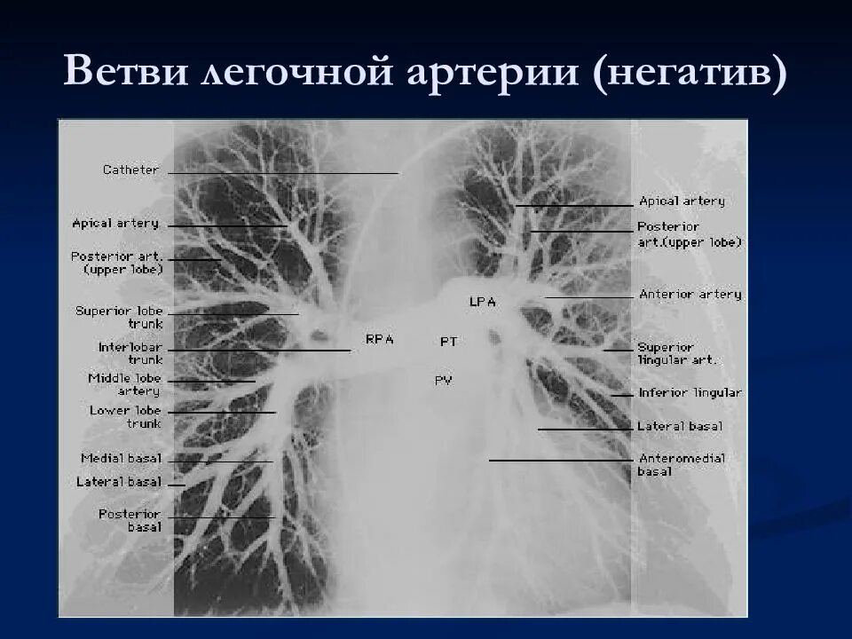 Сегментарные ветви легочной артерии. Легочные артерии анатомия. Строение легочной артерии. Ветви легочной артерии на кт анатомия. Сколько легочных артерий