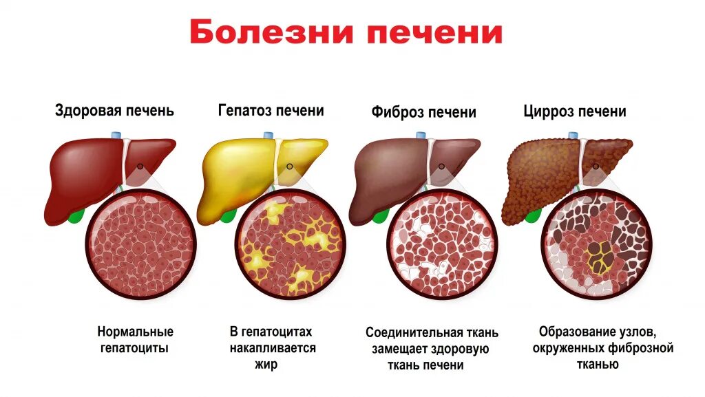 Печень фото человека анатомия. Liver disease. Liver disease. Liver disease. Liver disease.