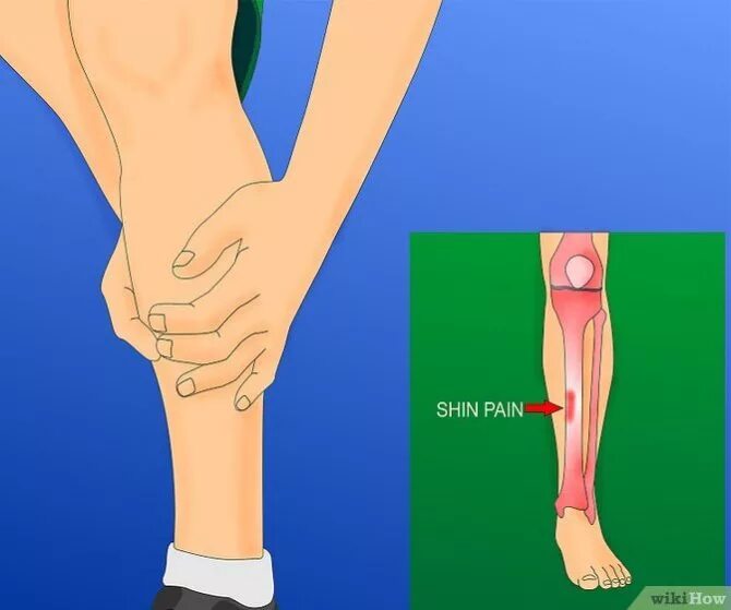Почему болит кость ноги спереди. Воспаление надкостницы (шинсплинт). Боль в надкостнице голени.