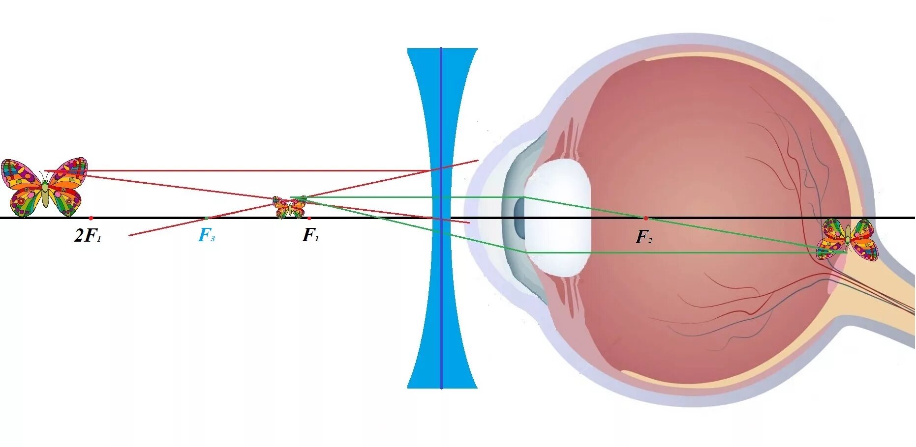 Изображение на сетчатке глаза появляется. Миопия двояковогнутые линзы. Двояковогнутая линза для близорукости. Двояковогнутые линзы при близорукости. Линзы для глаз для зрения дальнозоркость.