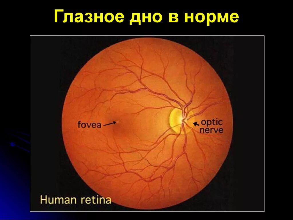 Норма зрительного нерва. Офтальмоскопия глазного дна норма. Описание глазного дна в норме. Нормальная картина глазного дна.