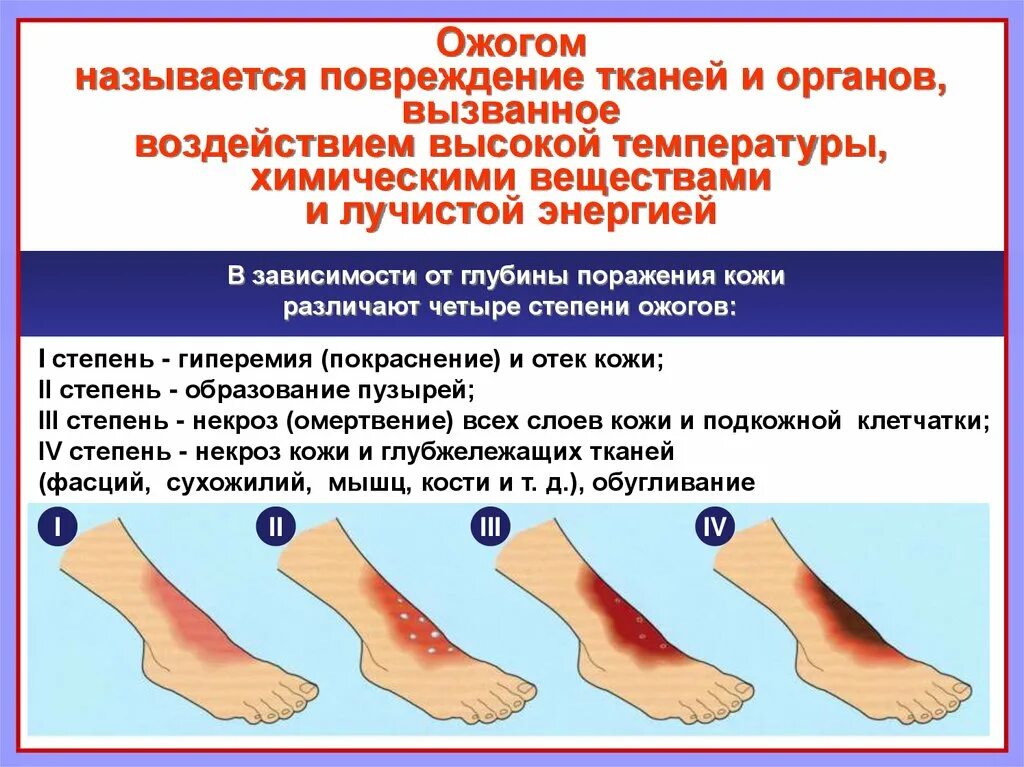 Помощь при различных видов ожогов. Клинические проявления термического ожога ii степени:. характерный признак термического ожога iv степени. степень ожога пмп 4 степени. термический ожог 1 и 2 степени симптомы и первая помощь.