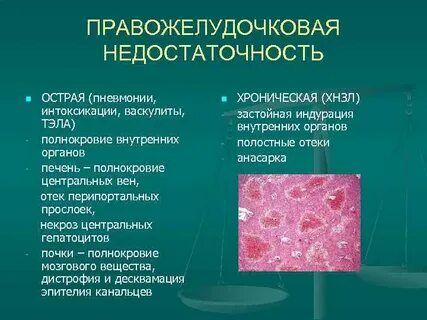 Острая правожелудочковая недостаточность