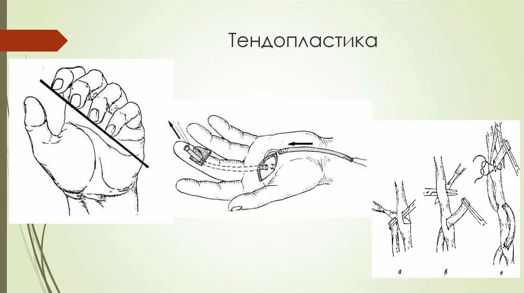 Повреждения сухожилия пальца. Шов сухожилия разгибателя 1 пальца. шов сухожилия разгибателя 1 пальца кисти. двухэтапная пластика сухожилий сгибателей кисти. зоны повреждения сухожилий сгибателей.