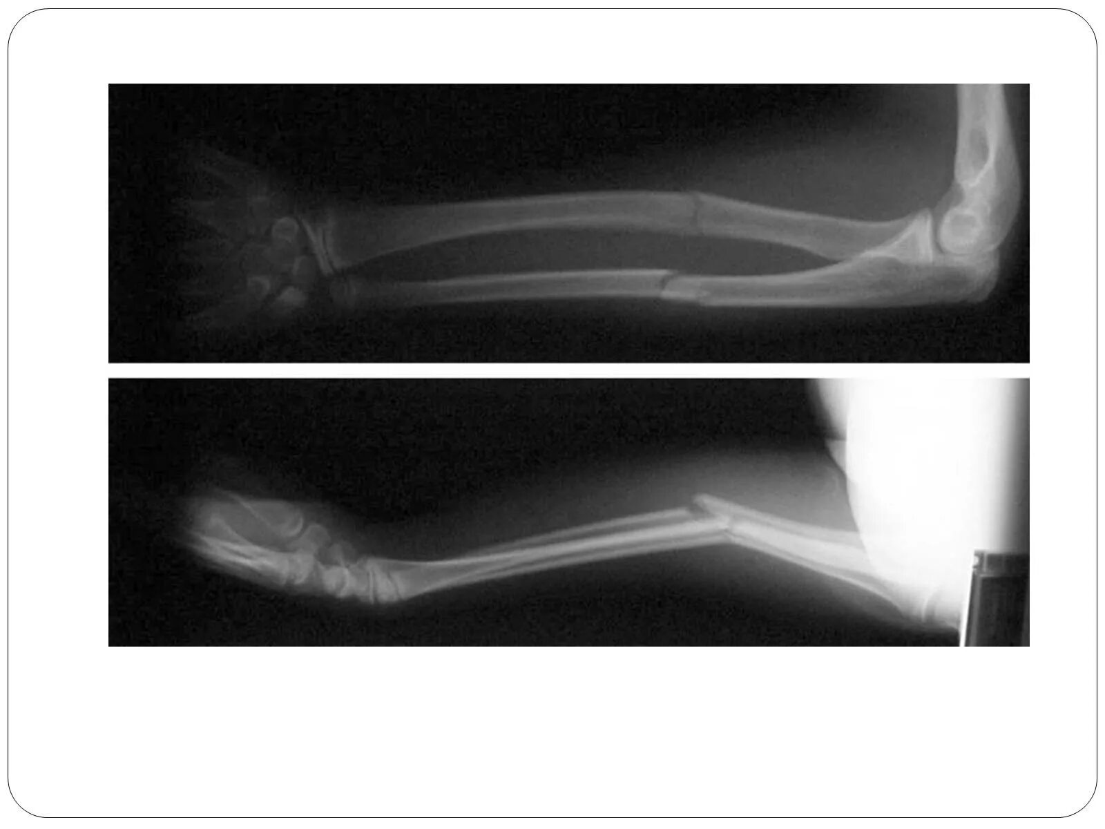 Смещение кости на руке без перелома. Перелом диафиза лучевой кости гипс. Перелом диафиза лучевой кости рентген. Перелом диафиза локтевой кости. Перелом диафиза костей предплечья.