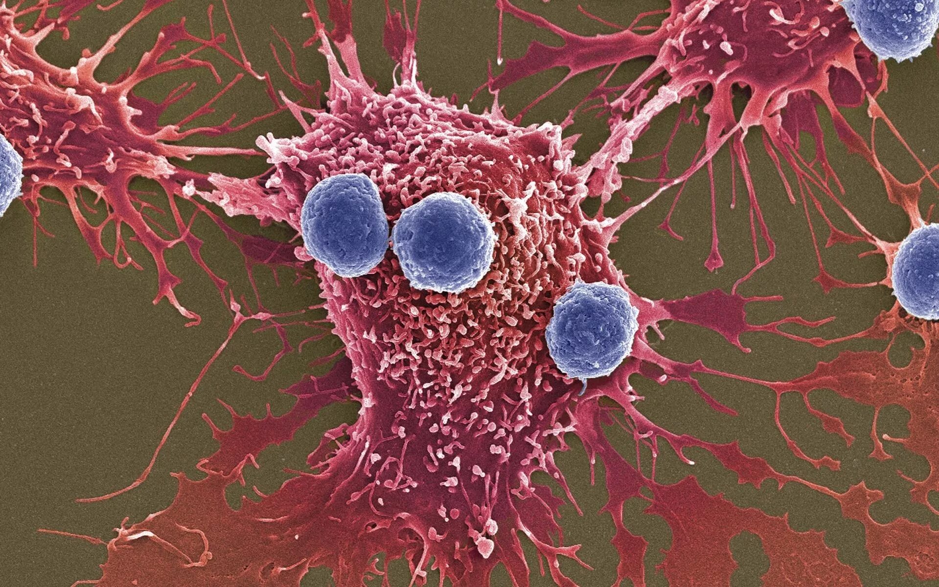 Злокачественная опухоль. Раковая клетка и т лимфоцит. Опухолевые клетки микроскоп. Т лимфоциты микроскоп. Т лимфоциты гистология онкология.