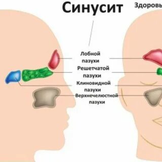 Ринит и синусит