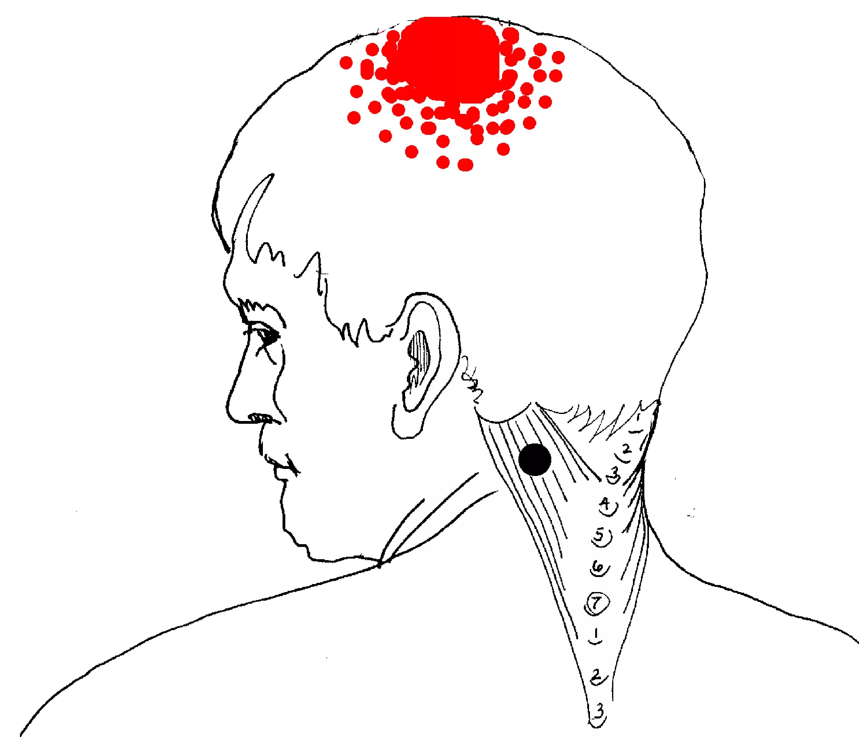 Висок ухо глаз. Триггерные точки при головной боли. Триггерная точка боли в затылке. Болит на затылке воднгй точуе. Точки на темени головы.