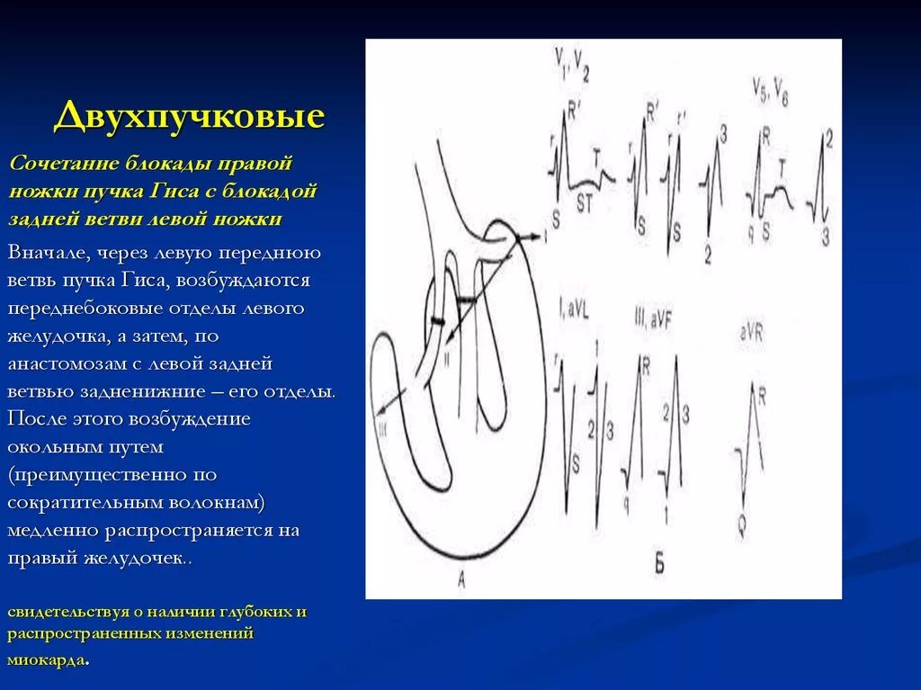Блокада задней ветви левой ножки пучка Гиса. Двухпучковые блокады на ЭКГ. Двухпучковая блокада ножек пучка Гиса на ЭКГ. Трехпучковые блокады ножек пучка Гиса на ЭКГ.