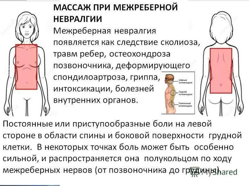 Межрёберная невралгия спереди ребра. Межреберная невралгия симптомы. Межребреная неврология. Межреберная неврология симтомы. Чем снять межреберную невралгию