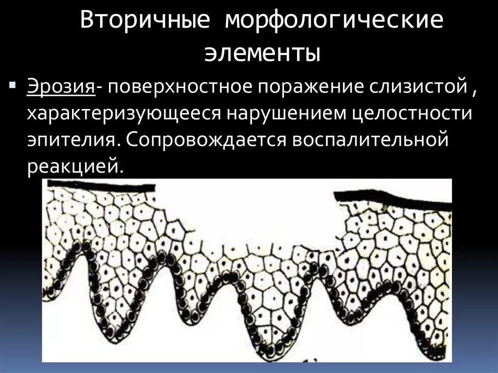 Вторичные элементы поражения. Вторичные элементы поражения слизистой оболочки. Морфологические элементы поражения сопр первичные и вторичные. Эрозия вторичный морфологический элемент. Первичные и вторичные элементы поражения слизистой оболочки.