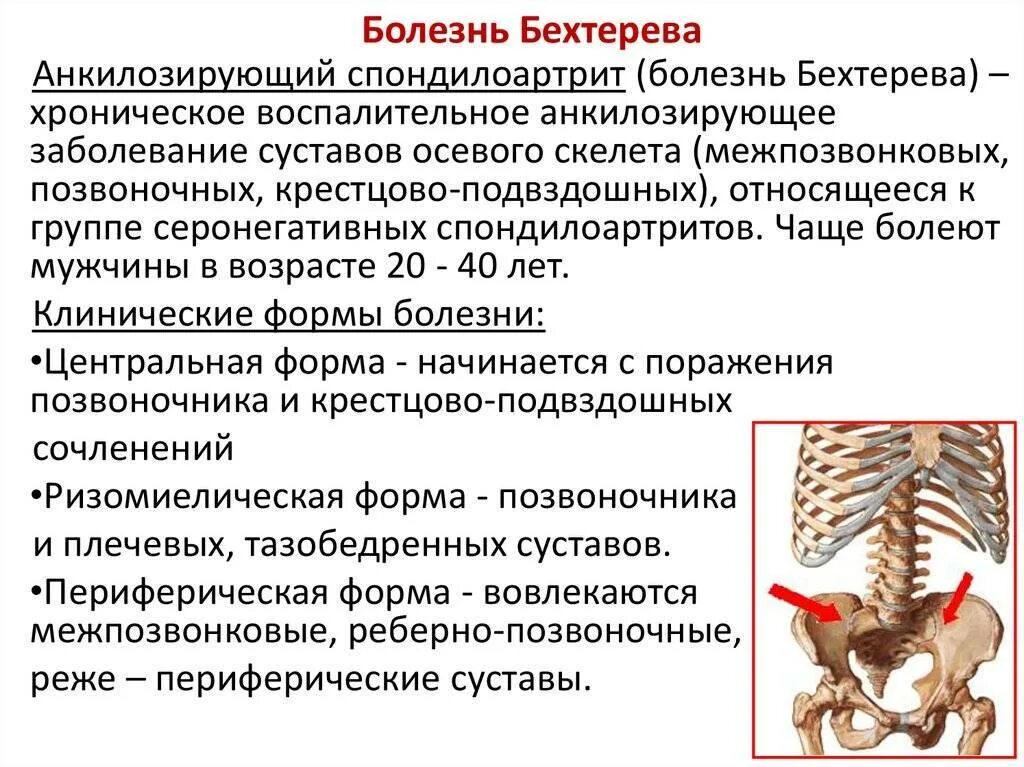 Бехтерева анкилозирующий спондилоартрит. Анкилозирующий спондилит крестцово подвздошного сочленения. анкилозирующий спондилез. анкилозирующий спондилоартрит болезнь бехтерева. болезнь бехтерева эпидемиология.