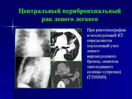 Симптом восходящего солнца
