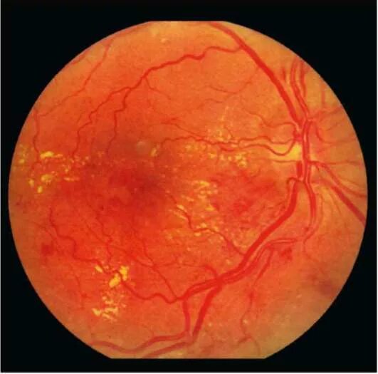 Гипертоническая ретинопатия глазное дно. Гипертоническая ретинопатия клинические рекомендации. Ангиосклероз сетчатки. Почечная гипертоническая ретинопатия. Изменение на глазном дне