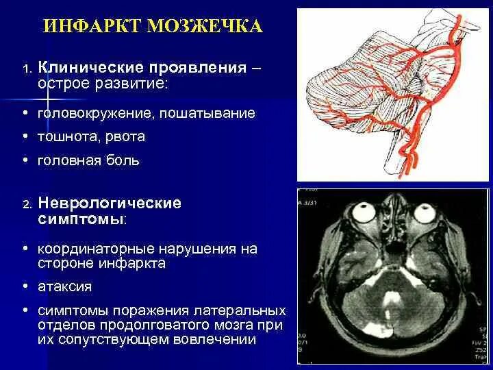 Инсульт правая сторона мозга последствия. Ишемический инсульт мозжечка кт. Инфаркт мозжечка кт. Инфаркт мозжечка артерии. Кт опухоли мозжечка головного.