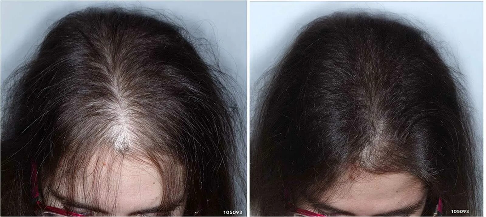 Как остановить выпадение волос после. Андрогенная алопеция алопеция. Андрогенная алопеция Гамильтон. Диффузная телогеновая алопеция.