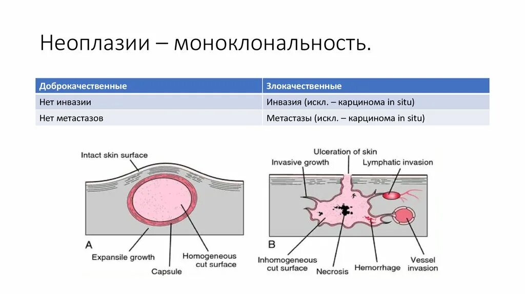 Неоплазия лечение. Интраэпителиальная неоплазия. Цервикальная неоплазия. Внутриэпителиальная неоплазия.