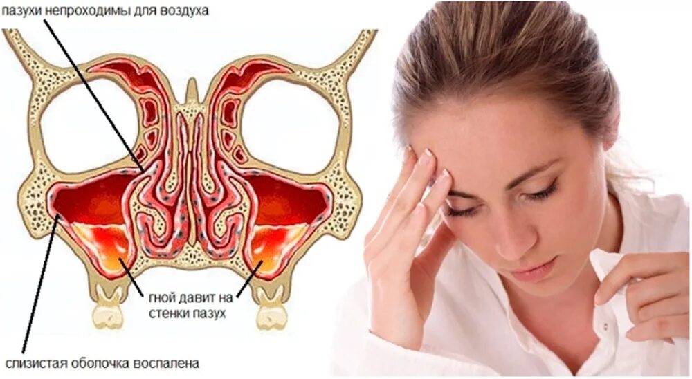 Заболевания головные заболеваниях носа