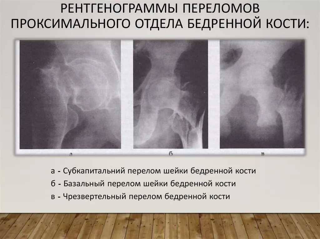 Закрытый чрезвертельный перелом бедренной кости. Перелом проксимального отдела бедренной кости. Перелом проксимального отдела бедра рентген. Субкапитальный перелом шейки бедра рентген.