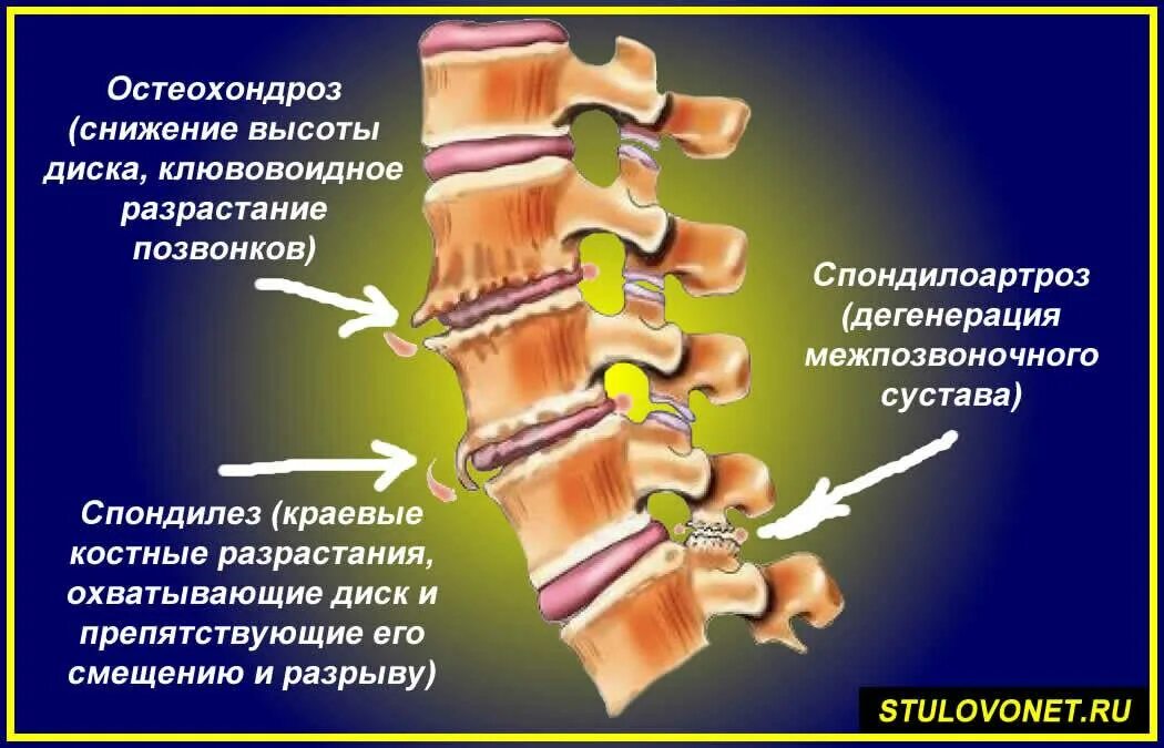 Остеофиты что это такое и как лечить. Деформирующий спондилез спондилоартроз. Остеохондроз деформирующий спондилоартроз и спондилёз. Спондилез l2-l4. Спондилез th10 - th11.