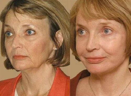 #SkincareHacks Skincare Hacks in 2019 Combination skin care, Skin peeling on fac