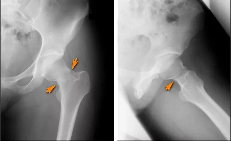 Вколоченный перелом шейки бедра рентген. Аддукционный перелом шейки бедра рентген. Субкапитальный перелом шейки бедра рентген. Перелом шейки бедренной кости рентген. Последствия перелома шейки бедра