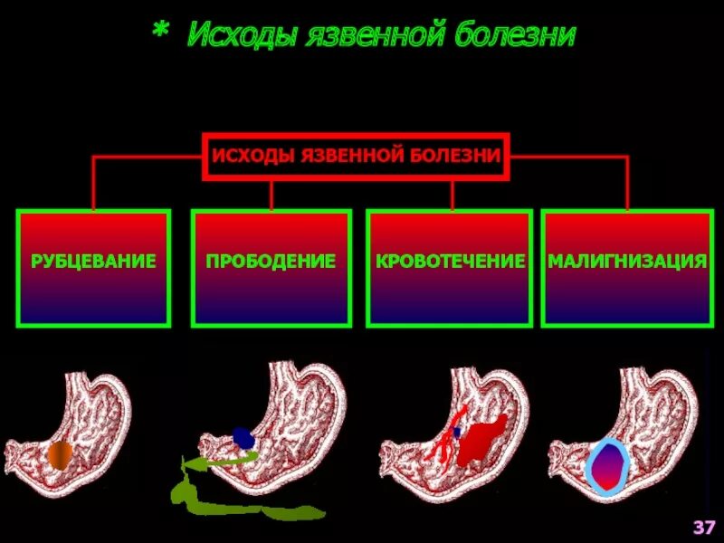 Язвенная болезнь желудка кровотечение. Исходы язвенной болезни желудка. Язвенная болезнь желудочное кровотечение. Язвенная болезнь желудка исходы и осложнения. Осложнения желудка 12 перстной кишки