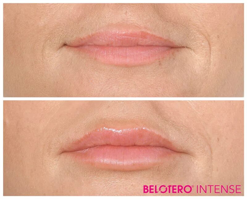 Kontūrplastika ar preparātu Belotero ®, Merz Pharma (Vācija) - Art Of Beauty - A