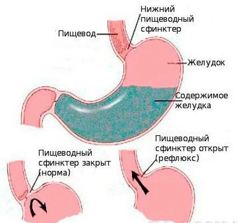 Симптомы желчи в пищеводе