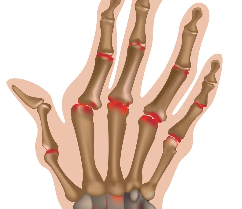 Ревматоидный артрит суставы. Ревматоидный артрит кистей пальцев рук. Подагра ревматоидный артрит кистей. Ревматоидный артрит фото суставов. Артрит фаланговых суставов