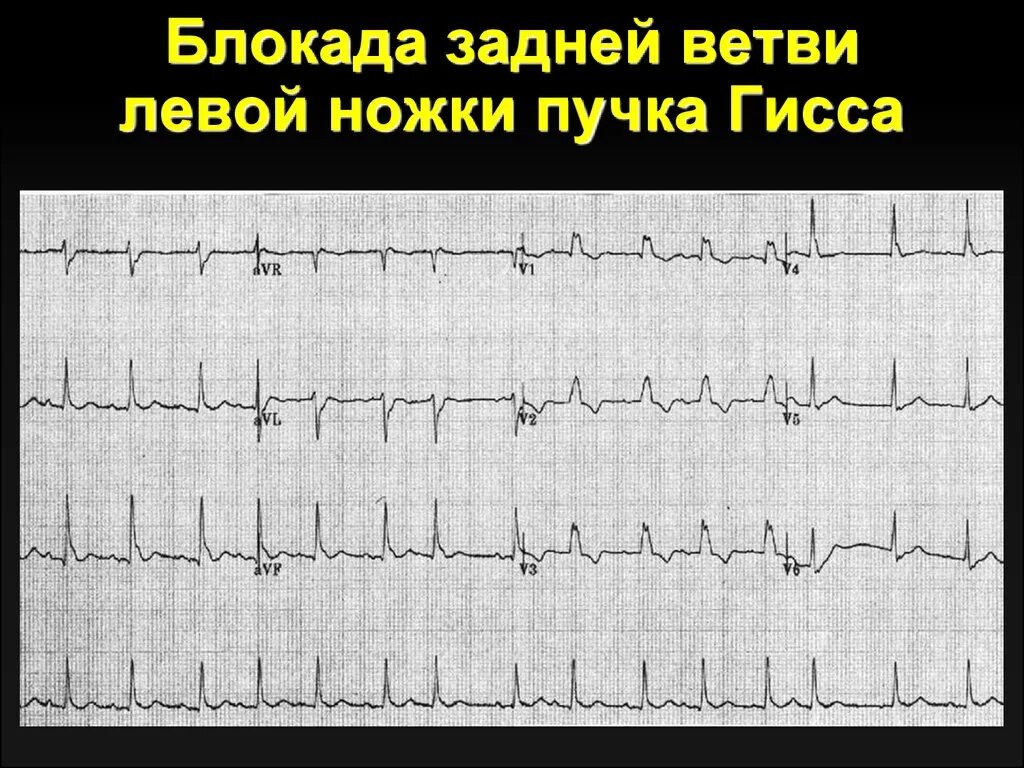 Неполная блокада передней. Блокада задней ветви ЛНПГ на ЭКГ. Блокада задней ветви левой ножки на ЭКГ. Неполная блокада задней ветви ЛНПГ. Блокада задней ветви левой ножки пучка Гиса на ЭКГ.