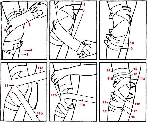 Как перевязывать колено. Схема бинтования коленного сустава эластичным бинтом. Схема бинтования колена эластичным бинтом. Как правильно намотать эластичный бинт на колено для фиксации. Как правильно фиксировать колено эластичным бинтом.