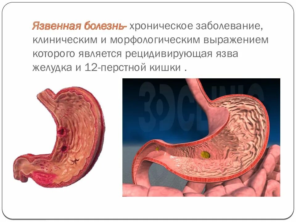 Для язвенной болезни 12-перстной кишки характерно. Язвенная болезнь 12 перстной кишки клинические рекомендации. Язвенная болезнь это хроническое циклическое. Задачи 12 перстной кишки.