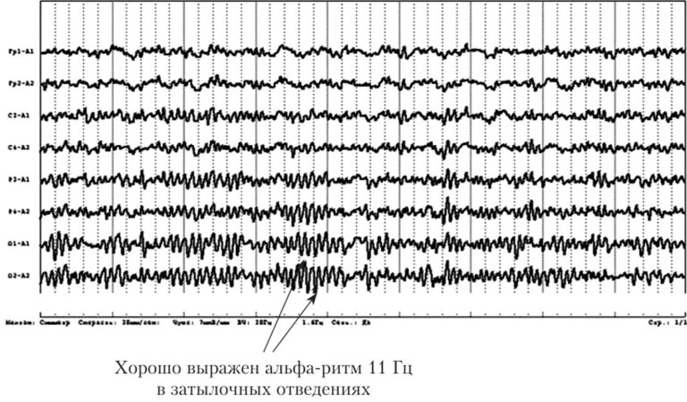 Диффузная активность ээг. Норма Дельта ритма на ЭЭГ. Дельта ритм на ЭЭГ У взрослых. ЭЭГ головного мозга ритмы. Амплитуда ритмов ЭЭГ.