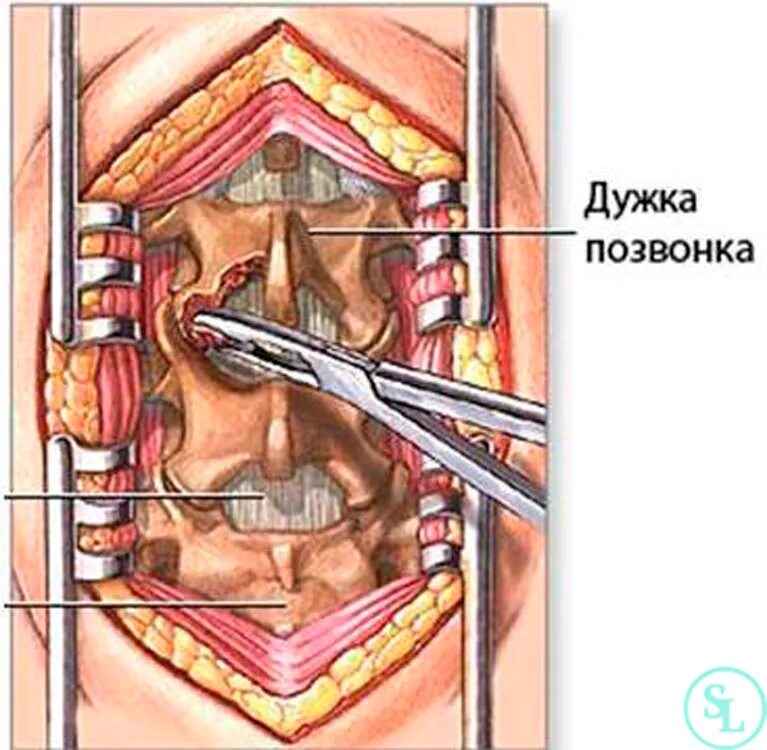 Декомпрессия Корешков спинного мозга. Операция ламинэктомия на позвоночнике. Декомпрессия Корешков позвоночника. Декомпенсированная ламинэктомия.