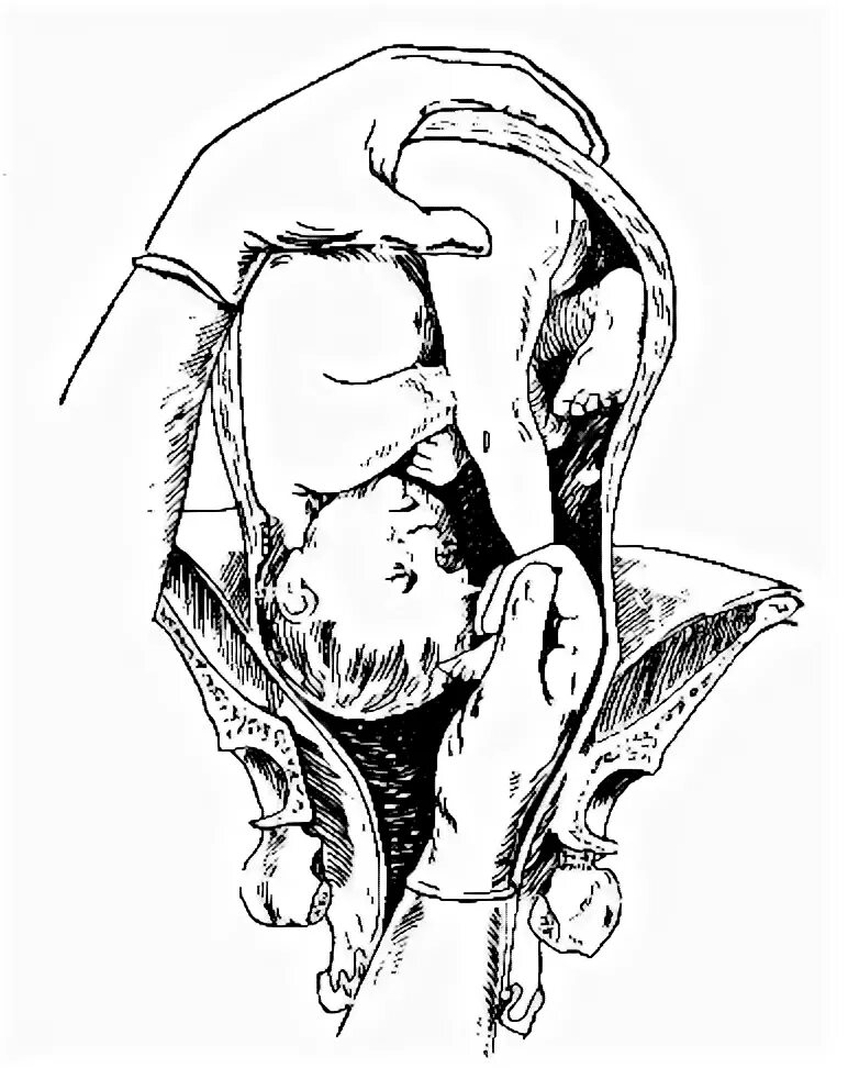 Амбруаз паре поворот плода на ножку. Поворот плода на ножку. Аккшерский поворотпложа. Поперечное головное предлежание плода. Амбруаз паре поворот плода на ножку.