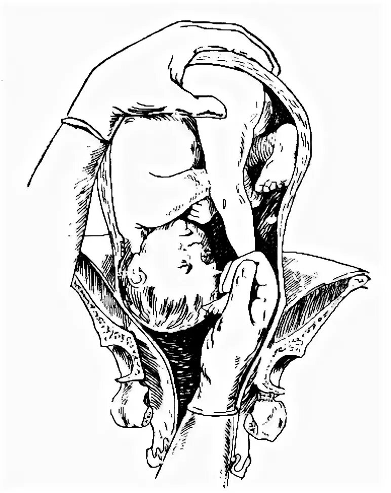 Амбруаз паре поворот плода на ножку. Амбруаз паре Акушерство. Поворот плода по Брекстону Гиксу. Наружный акушерский поворот плода.