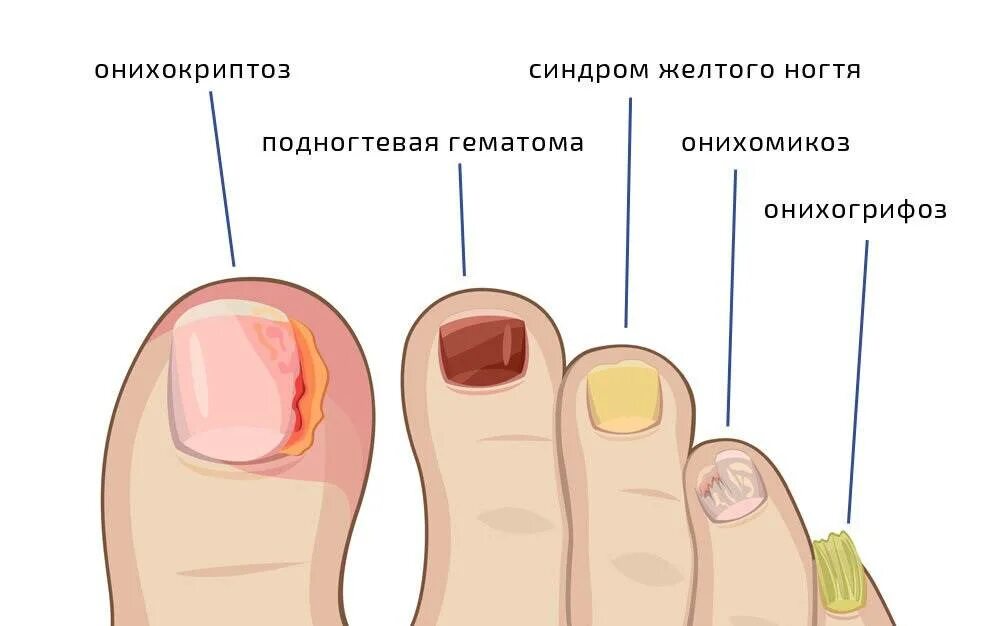 Ногти на ногах стали
